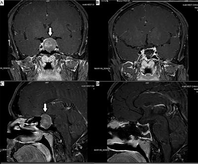 Progress in the Pathogenesis, Diagnosis, and Treatment of TSH-Secreting Pituitary Neuroendocrine Tumor